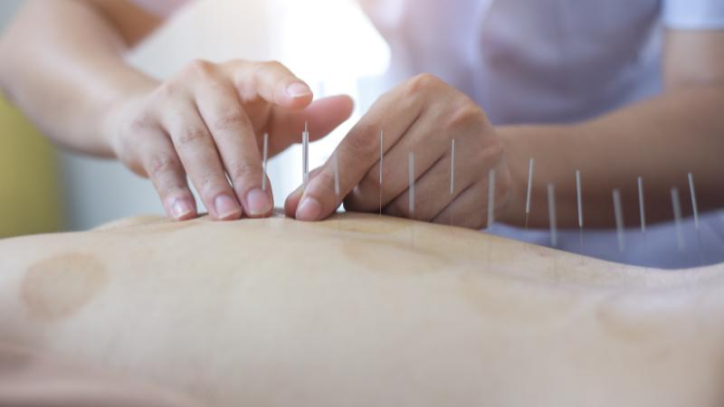 Tratamiento Acupuntural